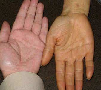 胡萝卜素血症怎么治疗 胡萝卜素血症 胡萝卜素血症如何治疗？