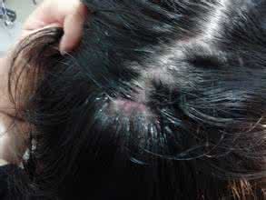 干性脂溢性皮炎治疗 干性脂溢性皮炎 如何治疗干性脂溢性皮炎