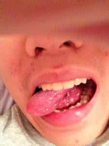 艾滋病舌头症状图片 艾滋病初期舌头症状 艾滋病初期症状舌头 得了艾滋舌头会变化