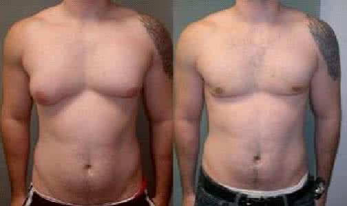 男性乳腺增生会自愈吗 男性乳腺增生 男性为什么会患上乳腺增生