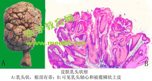 外阴鳞状上皮细胞增生 外阴鳞状上皮细胞增生 外阴细胞增生的病理