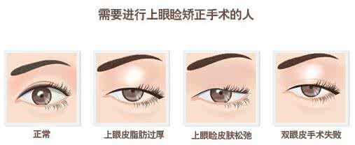 做上睑下垂矫正术 做上睑下垂矫正术 上睑下垂矫正术解析