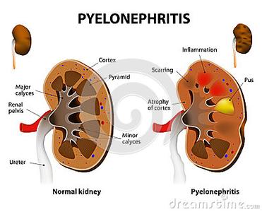 肾盂肾炎治疗方法 肾盂肾炎4方