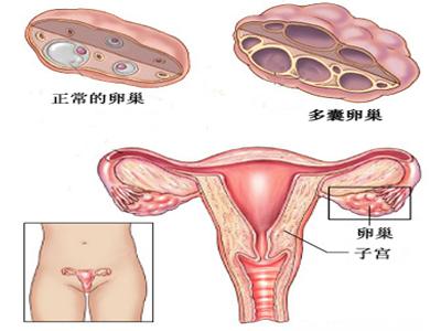 多囊性卵巢综合症 多囊性卵巢综合症 多囊卵巢综合症怎么办 预防多囊卵巢综合症