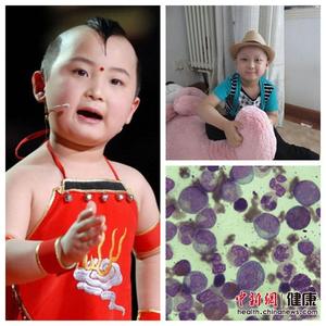 白血病会遗传吗 白血病遗传吗 如何预防白血病