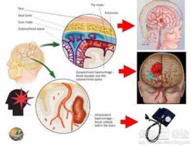 治疗脑出血的特效药 脑出血治疗 导致脑出血的原因有哪些