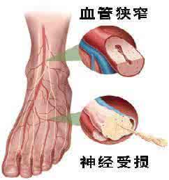 糖尿病动眼神经麻痹 糖痹外洗方糖尿病周围神经病变