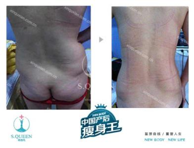 孕妇骨盆测量 骨盆测量怎么测 骨盆测量,孕麻麻知道多少?