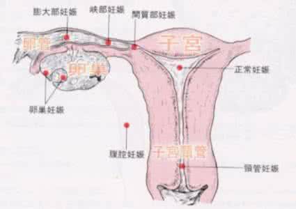宫外孕怎么办严重吗 发现宫外孕后怎么办