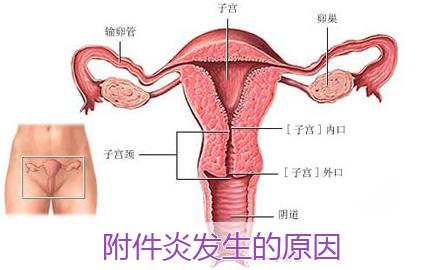 引起附件炎的原因 引起附件炎的原因？