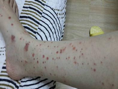 治疗过敏性紫癜的方法 过敏性紫癜治疗 治疗过敏性紫癜的方法