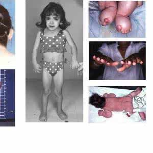 特纳综合征的临床表现 特纳综合征 特纳综合征的临床表现