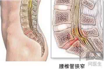 腰椎管狭窄治疗方法 治疗腰椎管狭窄的方法 腰椎管狭窄的治疗方法中哪种可靠