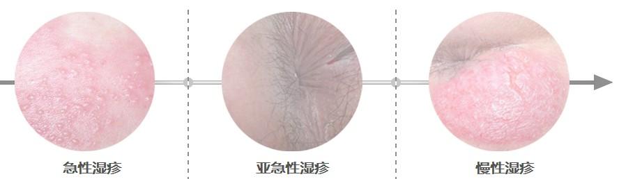 肛门湿疹吃什么蔬菜好 肛门湿疹吃什么蔬菜好 湿疹，岂一个“湿”字了得？4种蔬菜效果神奇··