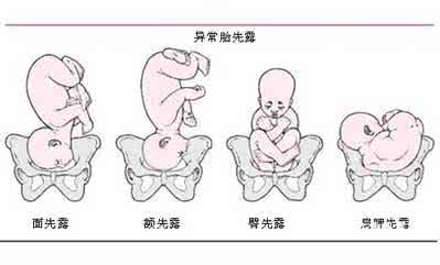 臀位是什么原因造成的 胎位不正是什么原因