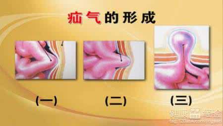 疝气微创手术复发几率 疝气会复发吗？