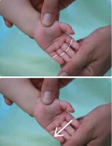 小儿推拿病例分析 最全小儿推拿,不吃药,解决日常小病!