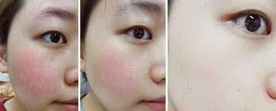 红血丝根治的偏方大全 红血丝能根治吗