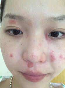 皮肤过敏治疗方法 吃什么治皮肤过敏 皮肤过敏的护理方法是有哪些