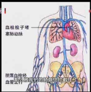 养生堂血栓 《养生堂》全世界严重的公众疾病 血栓的危害