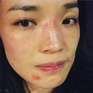 面部过敏性皮炎偏方 面部过敏性皮炎 治疗面部过敏性皮炎有偏方