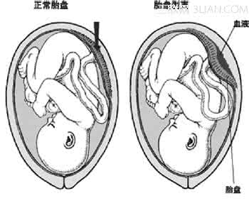 胎盘早剥的预防措施 胎盘植入的预防措施