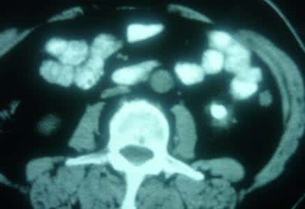 肾结石 科学网科学家意外发现肾结石排石药