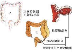 白点的发病原因有哪些 食管憩室 它的发病原因有哪些