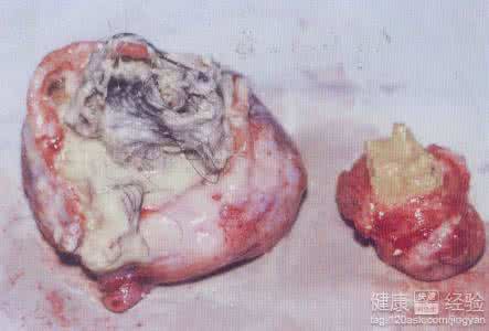 卵巢畸胎瘤形成原因 左卵巢畸胎瘤是怎么回事