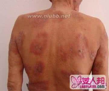 麻风病是什么引起的 麻风病是什么引起的 麻风病的病症