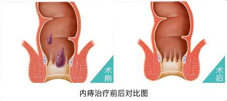 内痔一期怎么治疗 内痔怎么治疗 食疗也可治内痔