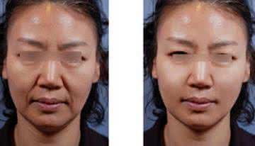 微创面部提升除皱 法令纹 微创面部提升除皱