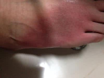 烫伤后怎样不留疤痕 烫伤不留疤秘方虎杖液