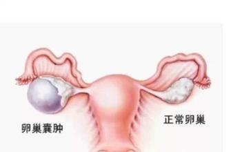 双侧卵巢囊肿怎么办 卵巢囊肿 卵巢囊肿怎么办
