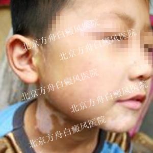 容易得皮肤病的原因 容易得皮肤病的原因 儿童容易得白癜风的原因