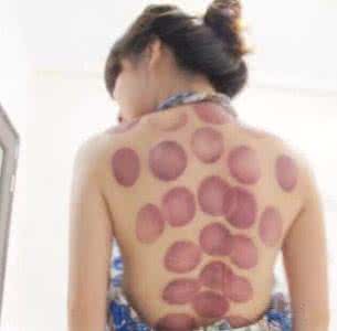 菏泽贸促会张莉 人人会拔罐·张莉