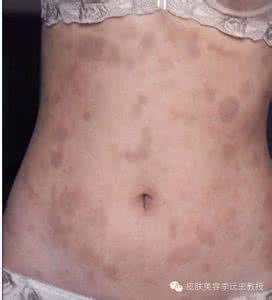 荨麻疹血管炎治疗 荨麻疹血管炎 如何治疗荨麻疹血管炎