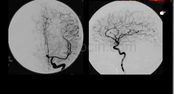脑血管造影 一文读懂脑血管造影，实用技巧！
