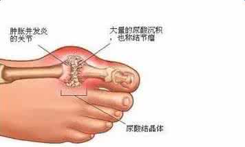 针灸治疗中风后遗症 針灸治療中風後遺症之臨床取穴(與靳三針比較)