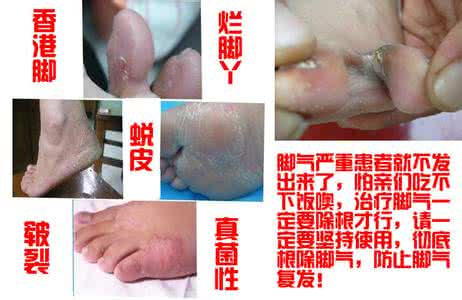 治脚气灰指甲的偏方 脚气和灰指甲的危害 灰指甲的危害和预防