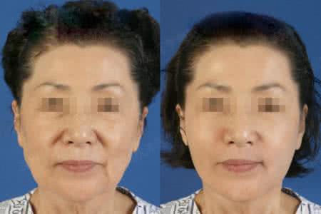 电波拉皮多少钱一次 电波拉皮 电波拉皮多少钱一次