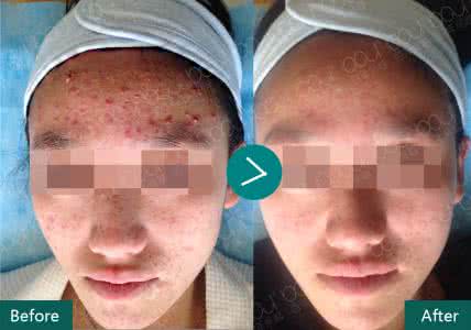 中医去痘痘 有中医去痘痘的方法吗