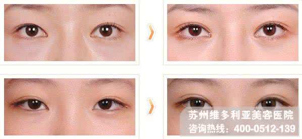 割双眼皮开眼角后遗症 割双眼皮的后遗症 开双眼皮后遗症 开双眼皮的后果是什么