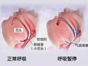 工作票三种人 三种人打鼾伤全身（专家呼声）