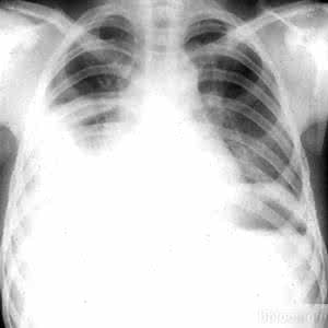 结核性胸膜炎传染吗 结核性胸膜炎传染吗 认识胸膜炎的传染性