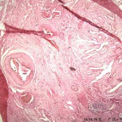 慢性胆囊炎症状有哪些 慢性胆囊炎 哪些原因会造成慢性胆囊炎