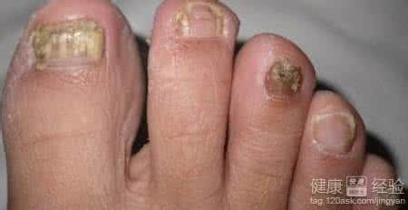 拔甲治疗灰指甲 治灰指甲最好的方法 是拔甲吗