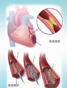 心脏支架手术后寿命 最缺德的手术 —— 心脏支架