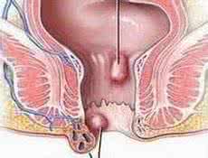 肛门湿疹 中医 肛门湿疹的中医治疗