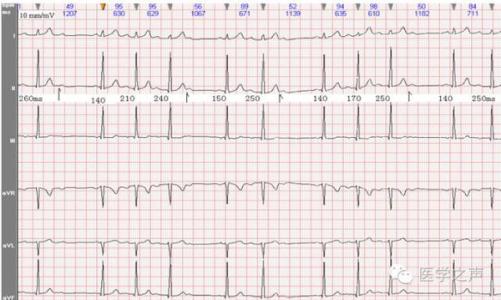 心电图教学视频全集 每天学看一份心电图（第26期）二度I型房室传导阻滞